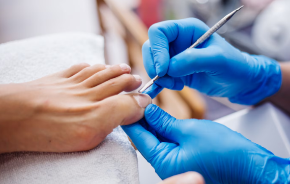 ¿Cuándo consultar a un especialista por uña encarnada?