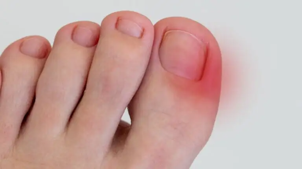 Una uña encarnada ocurre cuando uno de los bordes de la uña —generalmente del dedo gordo del pie— comienza a crecer hacia la piel que la rodea. Esto genera una molestia progresiva que puede ir desde un leve enrojecimiento hasta un dolor agudo e inflamación con pus. Es una condición mucho más común de lo que imaginamos y puede afectar a personas de todas las edades. Aunque muchas veces se piensa que es un problema menor, si no se trata a tiempo, puede complicarse e incluso afectar la forma en que caminamos.